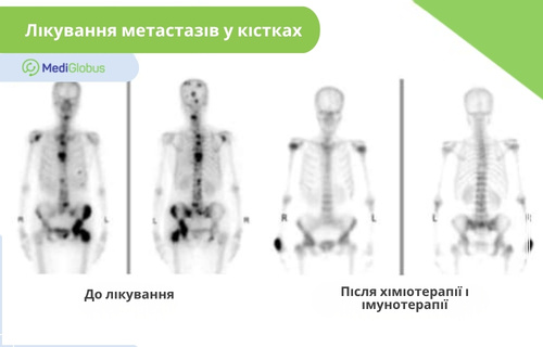 Лікування метастазів у кістках Порівняння стану кісток з метастазами до лікування і після хіміотерапії та імунотерапії