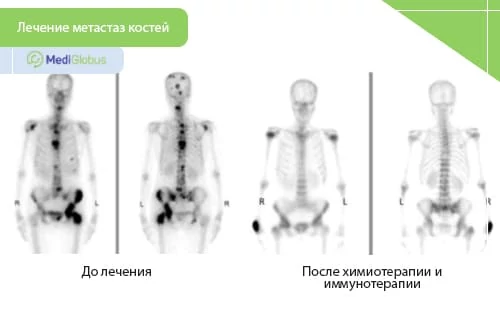 Лечение метастазов в костях Лечение метастазов в костях без выявленного первичного очага обычно включает медикаментозную терапию (бисфосфонаты, химио-, гормональные и таргетные препараты), а при симптомах — лучевую терапию или хирургическое вмешательство.