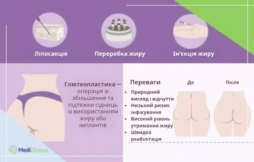 Інфографіка про особливості та переваги глютеопластики (операції зі збільшення сідниць)