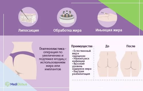 Инфографика про особенности и преимущества глютеопластики (операции по увеличению ягодиц)