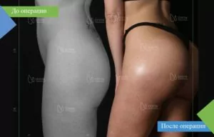 ягодицы до и после операции по увеличению