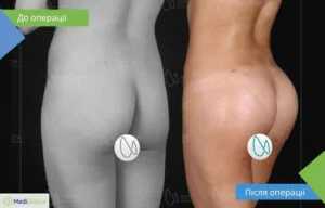 сідниці до та після операції зі збільшення