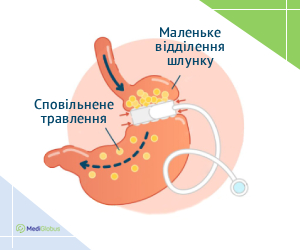 gastric_band_ukr Як проводиться бандажування шлунку схема