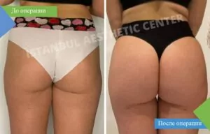 ягодицы до и после операции по увеличению