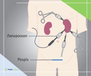 laporascopic_nephrectomy_ukr Лапароскопічна нефректомія операція з видалення нирки
