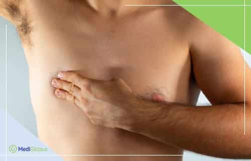 Что такое гинекомастия у мужчин и как проводить её лечение?