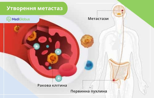 Як утворюються метастази Метастази - це поширення злоякісних клітин із первинної пухлини в інші органи