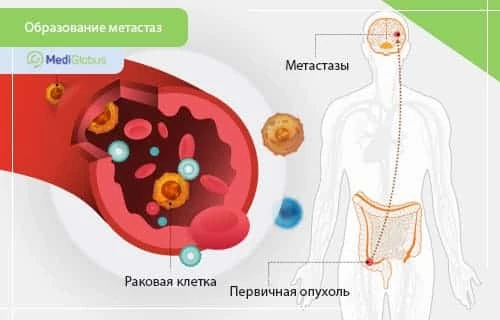 Как образуются метастазы Метастазы — это вторичные очаги рака, возникающие при распространении злокачественных клеток из первичной опухоли по кровеносной или лимфатической системе в другие органы, где они приживаются и продолжают рост.