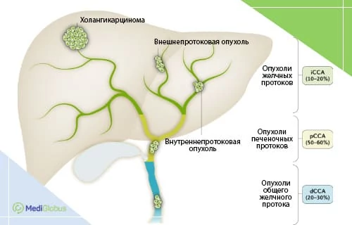 что такое холангиокарцинома — виды рака желчных протоков и их распространенность Инфографика: печень и желчные протоки с видами холангиокарциномы, их локализацией и частотой встречаемости