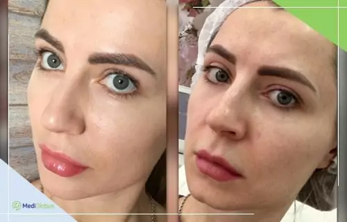 Facial contour correction with fillers