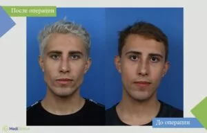 фото до и после пластики челюсти в испании
