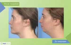увеличение кости челюсти операция