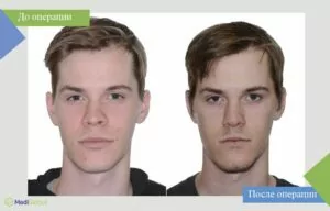 операция по коррекции нижней трети лица