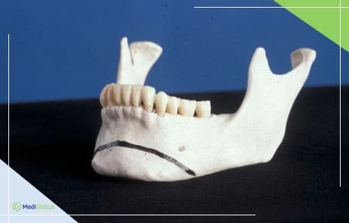 уменьшение челюсти операция
