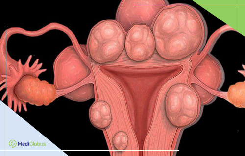 Рак (опухоль) матки - симптомы, причины, диагностика и лечение в лучших клиниках