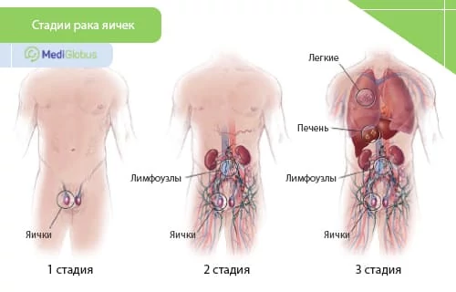 Лечение рака яичек по стадиям