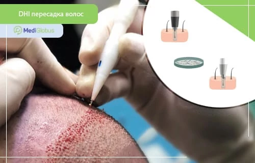 FUE, FUT, DHI — какой метод пересадки волос выбрать?
