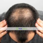 FUE, FUT, DHI - какой метод пересадки волос выбрать?
