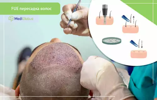 FUE, FUT, DHI — какой метод пересадки волос выбрать?