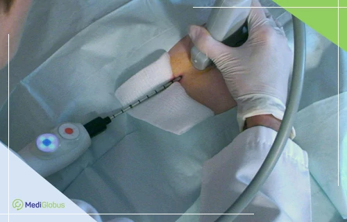 криоабляция фиброаденомы