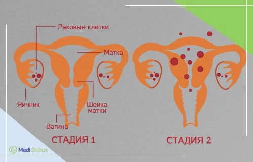 Рак яичников 1–2 стадии схематическое изображение строения женской половой системы и сравнение распространения раковых клеток на 1 и 2 стадиях
