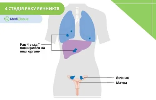 Метастази при раку яєчників 4 стадії схематичне зображення поширення метастазів при раку яєчників у легені та печінку