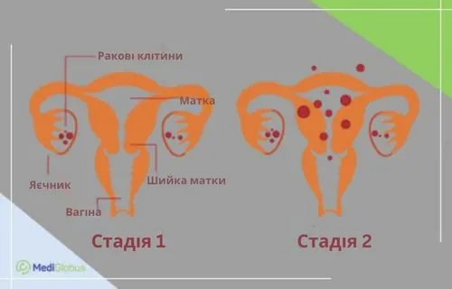 Рак яєчників на 1-2 стадії схематичне зображення будови жіночої статевої системи та порівняння поширення ракових клітин на 1-й і 2-й стадіях