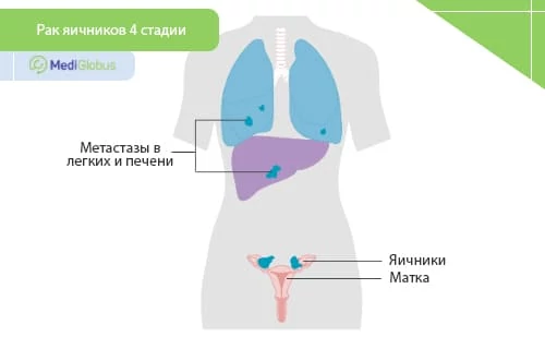 Где образуются метастазы при раке яичников 4 стадии? схематическое изображение распространения метастазов при раке яичников в легкие и печень