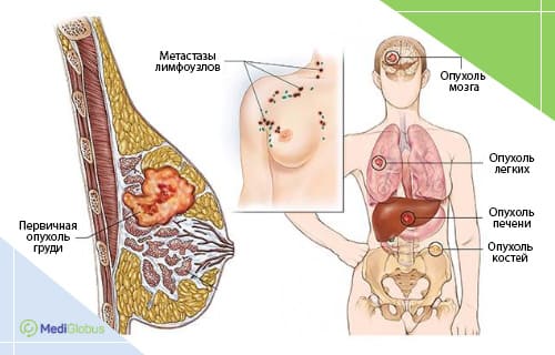 Симптомы и признаки рака груди