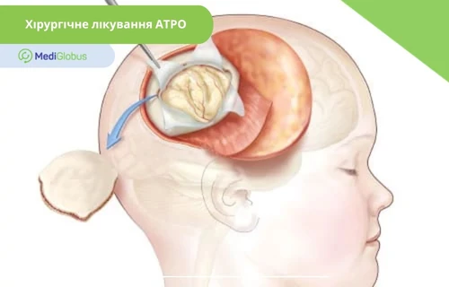 Як проводиться видалення тератоїдно-рабдоїдної пухлини головного мозку у дитини хірургічне видалення пухлини мозку у дитини, медична ілюстрація