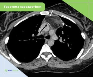 mediastinum_teratoma_ukr КТ знімок тератоми середостіння