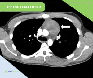 mediastinum_timoma_ukr КТ знімок тимоми середостіння