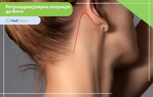 Ретроаурикулярний доступ під час операції да Вінчі Ділянка за вухом із нанесеною червоною лінією, що позначає передбачуваний розріз під час ретроаурикулярної операції за да Вінчі
