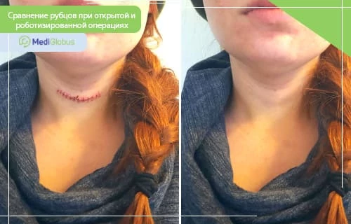 Сравнение шва на шее после открытой операции и после роботизированной: слева виден рубец со швами, справа — почти незаметный след