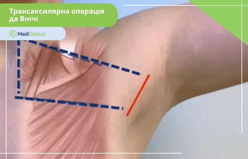 Трансаксилярний доступ під час операції за методом да Вінчі Область пахви з нанесеною схемою передбачуваного розрізу під час трансаксилярної операції за методом да Вінчі