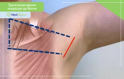 Трансаксиллярный доступ при операции да Винчи Область подмышки с нанесенной схемой предполагаемого разреза при трансаксиллярной операции да Винчи
