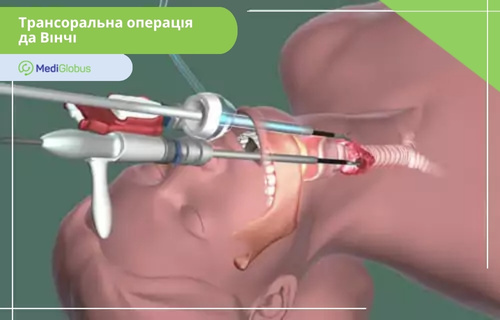 Трансоральний підхід да Вінчі Медична ілюстрація трансоральної операції да Вінчі — роботизовані інструменти вводяться через рот пацієнта для доступу до області шиї