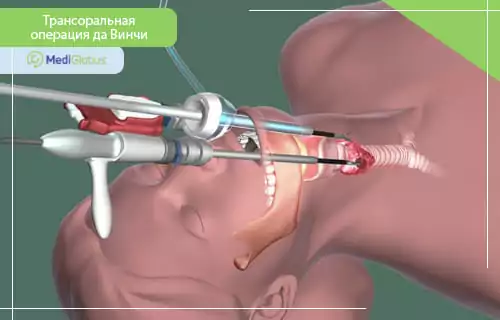 Трансоральный подход да Винчи Медицинская иллюстрация трансоральной операции да Винчи - роботизированные инструменты вводятся через рот пациента для доступа к области шеи