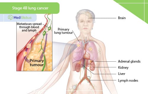 Is there hope for stage 4 lung cancer?