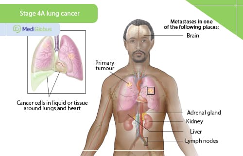 Is there hope for stage 4 lung cancer?