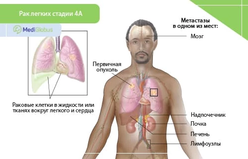 Инфографика: Рак легких 4 а стадия