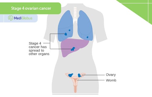 stage 4 ovarian cancer