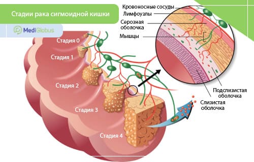 Симптомы долихосигмы и методы лечения