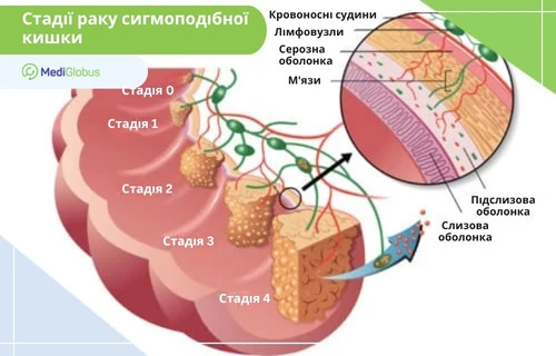 етапи розвитку раку кишечника — від ранньої стадії до метастазів із ураженням тканин і судин схема прогресування пухлини сигмоподібної кишки за стадіями з ураженням шарів та лімфовузлів