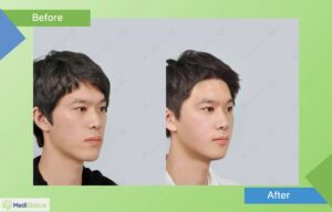 пластика лица мужчин до и после