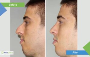 пластика лица мужчин до и после