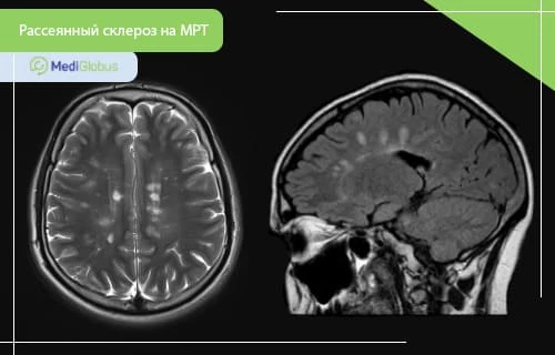 МРТ для диагностики рассеянного склероза МРТ-снимок головного мозга в двух проекциях