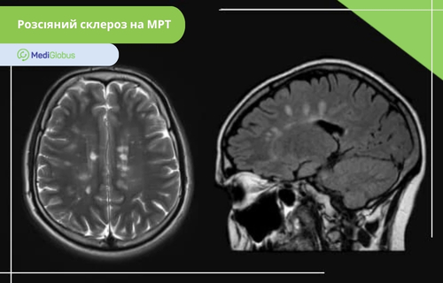 МРТ для діагностики розсіяного склерозу МРТ-знімок головного мозку у двох проекціях