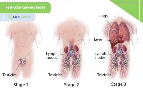 testicular cancer treatment by stage