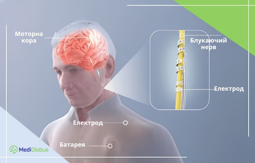 схема VNS-терапії — електрод на блукаючому нерві та імплант у грудній ділянці для стимуляції мозку